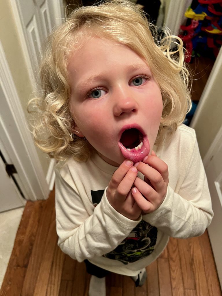 Desmond lost his first tooth!